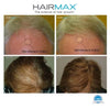 HairMax Ultima 12 LaserComb - Elegant Beauty